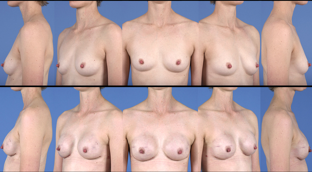Dr. Pestana's patient who received a breast reconstruction/implant. 