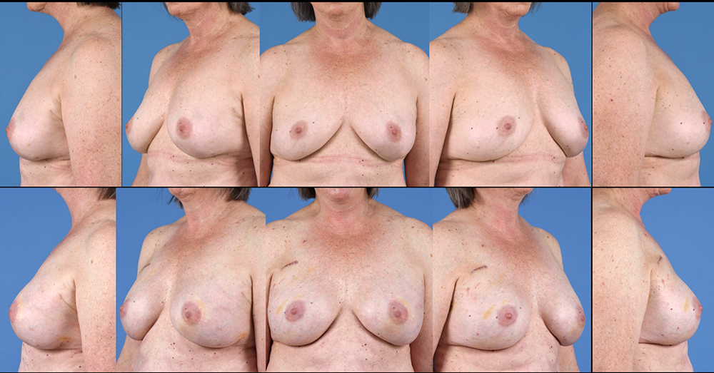 Dr. Pestana's patient who received a breast reconstruction/implant. 