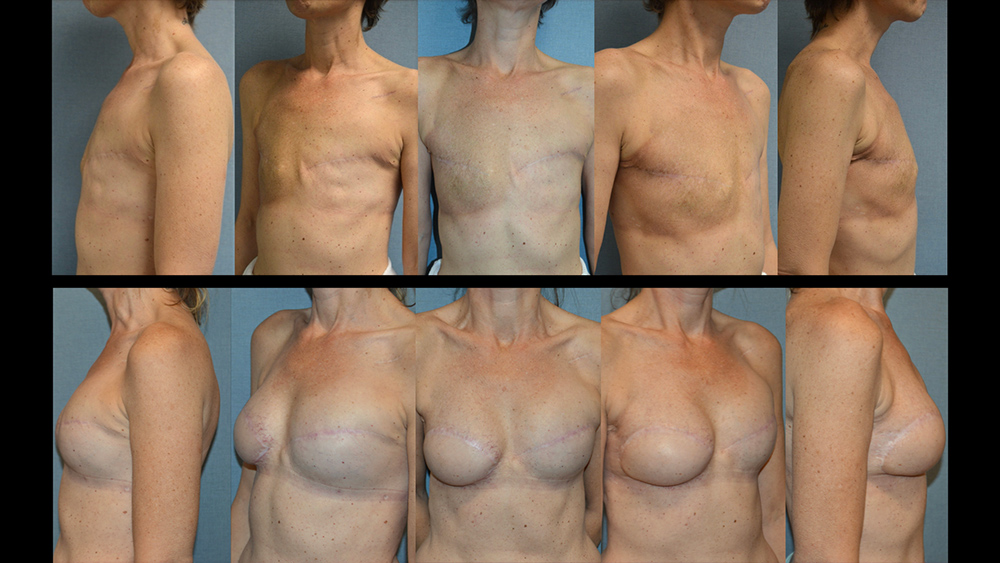 Dr. Pestana's example of breast reconstruction with autologous tissue. 