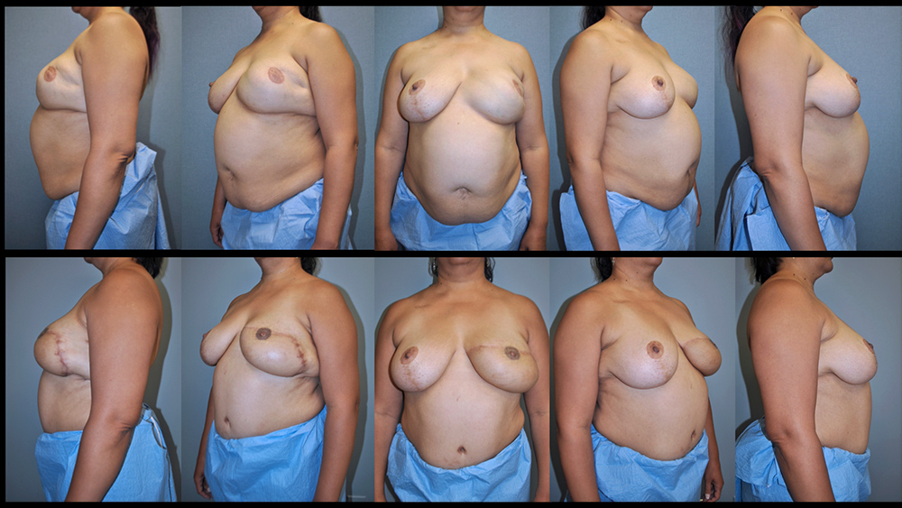 Dr. Pestana's example of breast reconstruction with autologous tissue. 