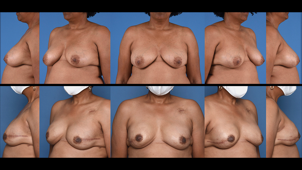 Dr. Pestana's example of breast reconstruction with implant.