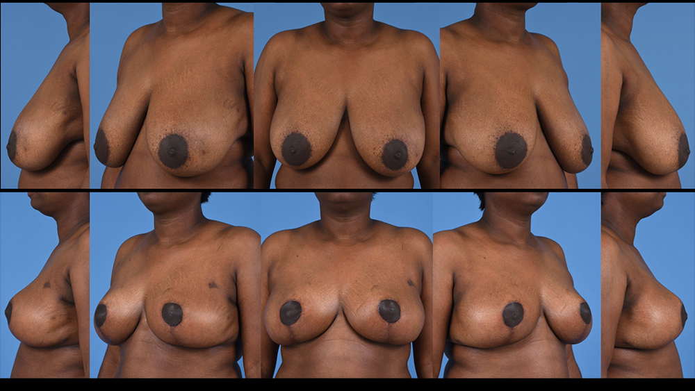 Dr. Pestana's example of oncoplastic breast reconstruction.