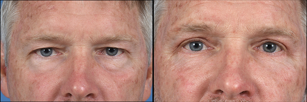Dr. Pestana's work on an upper eyelid blepharoplasty. 