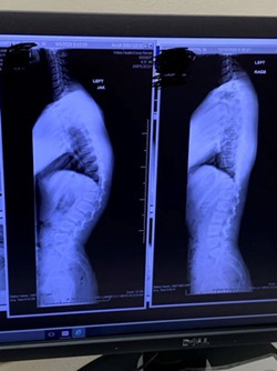 X-ray of Patient Griffin's Back