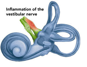 Inflammation of the vestibular nerve