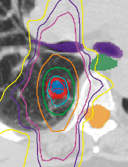Radiation Oncology in Lexington