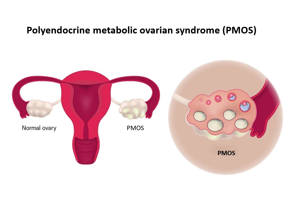 Illustration of a female reproductive system showing a normal ovary on one side and an ovary with polyendocrine metabolic ovarian syndrome (PMOS) on the other. The PMOS-affected ovary is enlarged and contains multiple fluid-filled cysts.