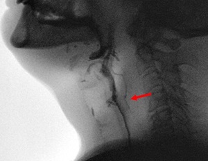 Example photo of after esophageal dilation. 