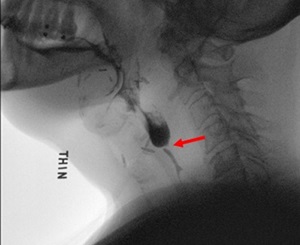 Example of before esophageal dilation.