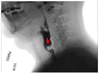 Cricopharyngeal Bar