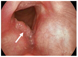 Example of Early Vocal Fold Cancer 