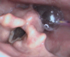 Internal view of an esophageal dilation.