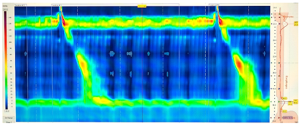Esophageal Manometry Test Example