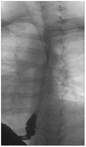 Esophagram example x-ray.