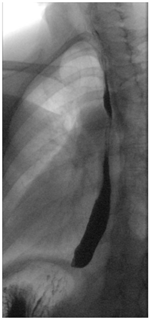 Esophagram example x-ray.