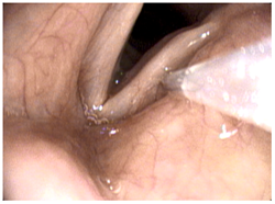 In-Office Vocal Fold Injection Augmentation example