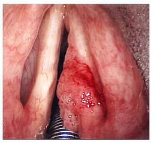 Laryngeal Papillomatosis example