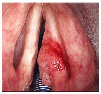 Laryngeal Papillomatosis example