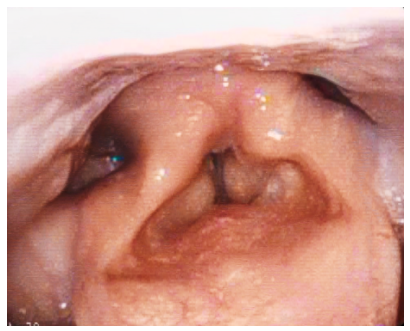 Example of muscle tension dysphonia.