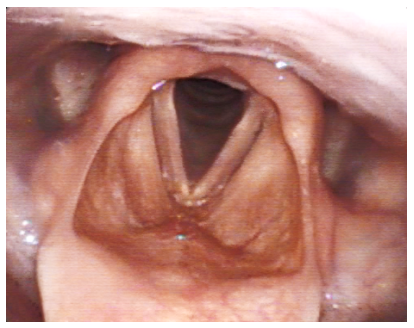 Example of muscle tension dysphonia.