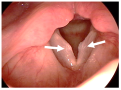 Vocal Cord Nodules