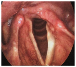 Example of vocal fold paresis and paralysis.
