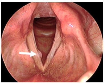 Vocal Cord Polyps