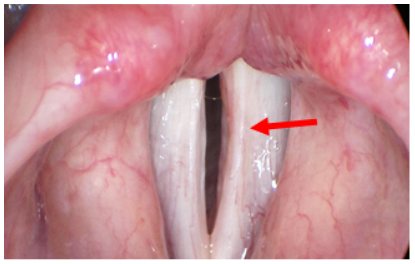Post operative Laryngeal Microsurgery example