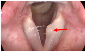 Pre operative Laryngeal Microsurgery example