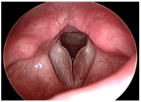 Reinke's Edema example