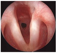 Subglottic and Tracheal Stenosis