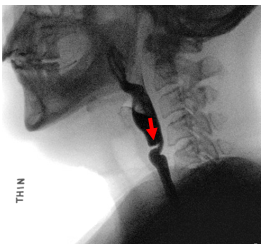 Upper Esophageal Web