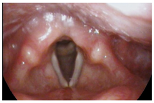 Example of vocal cord atrophy/aging voice.