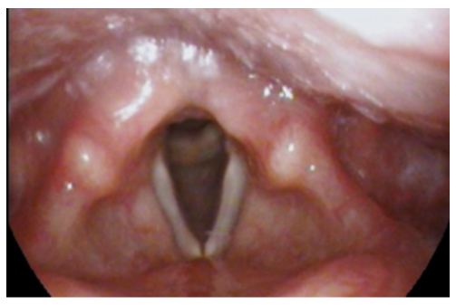 Example of vocal cord atrophy/aging voice.