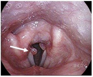 Vocal cord granuloma