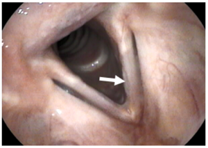 Vocal cord scarring example.
