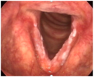 Example of Vocal Fold Leukoplakia and Dysplasia