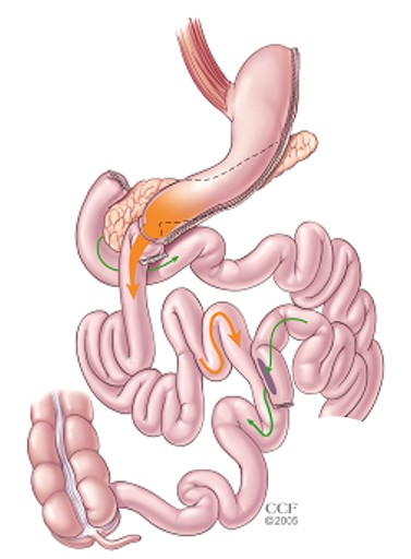 Duodenal Switch 