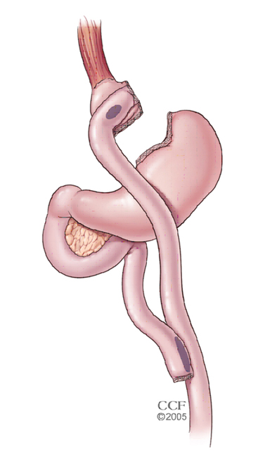 Roux-en-Y Gastric Bypass (RYGB) 