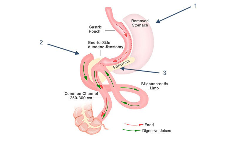 Roux-en-Y Gastric Bypass (RYGB) 
