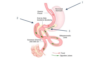 Roux-en-Y Gastric Bypass (RYGB) 