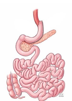 Sleeve Gastrectomy