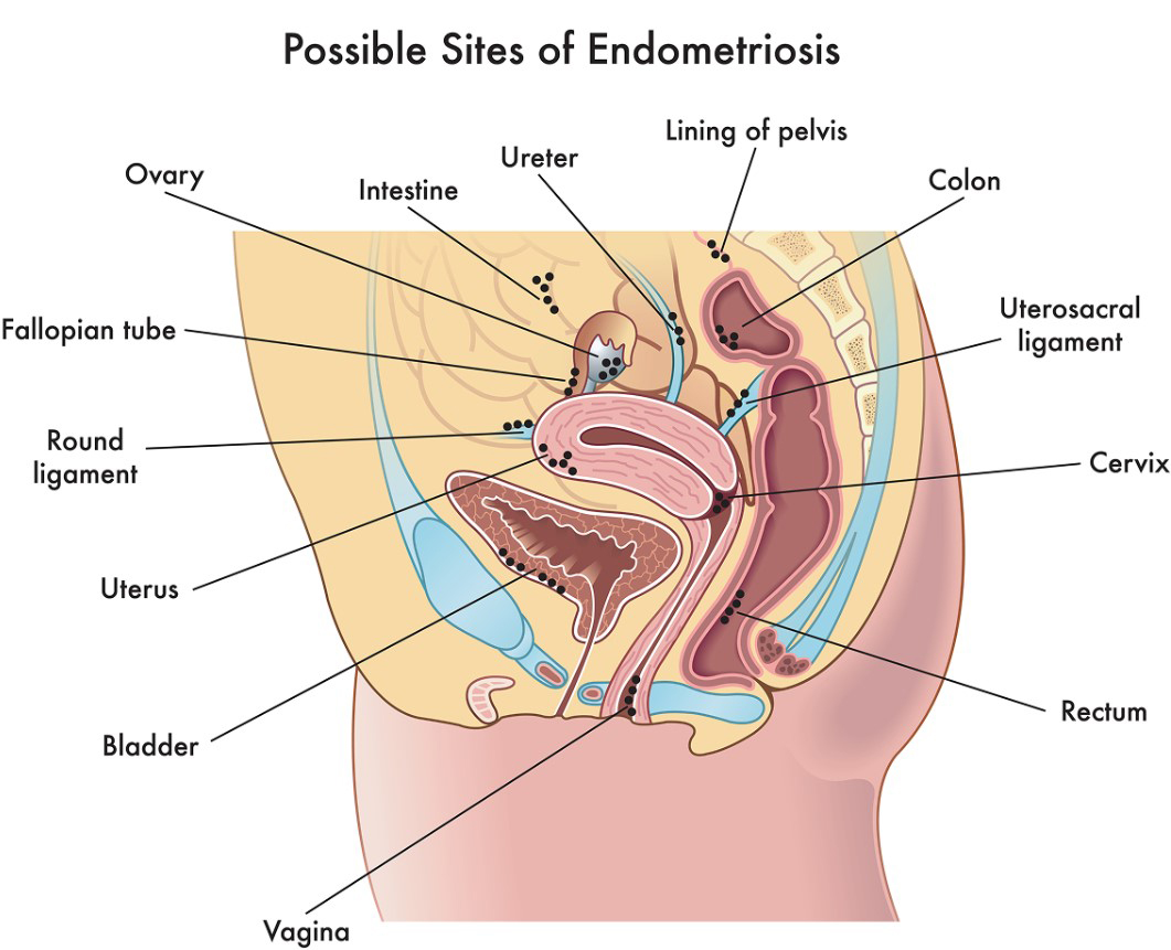 Image shows how sites of endometriosis can be found on reproductive organs, parts of the urinary tract, parts of the gastrointestinal tract and other areas of the abdomen.