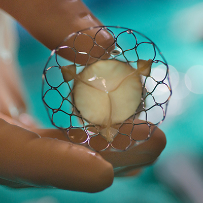 Close-up of a gloved hand holding a bioprosthetic valve, which is circular and trisected into three parts with a filigreed rim