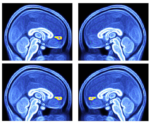 Scientists Succeed in Testing Potential Brain-based Method to Diagnose Autism
