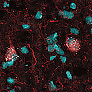 Scientists Identify Malfunctioning Brain Cells as Potential Target  for Alzheimer’s Treatment