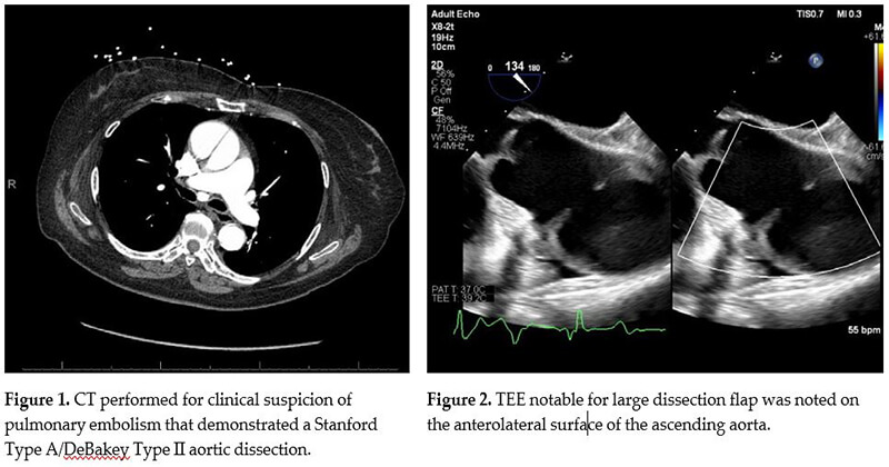 aortic dissection figure 1 2 ct tee