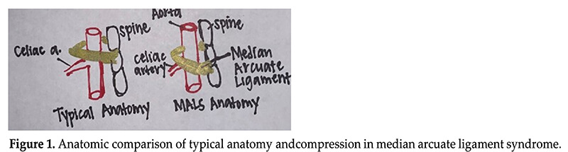 ligament syndrome figure 1 anatomic comparison