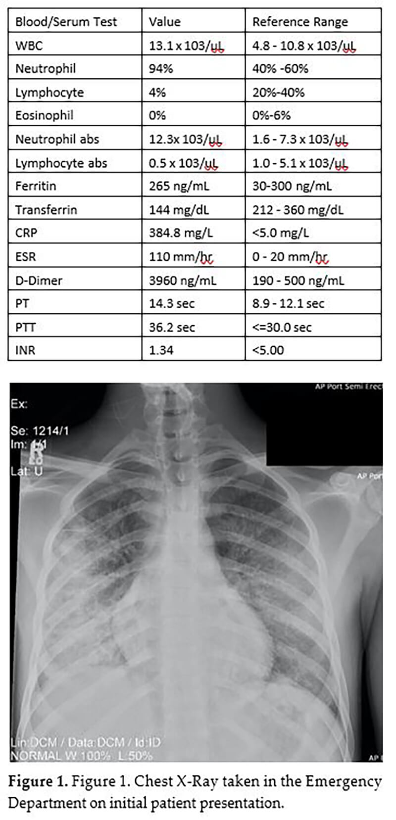 lung injury figure 1 chest x ray
