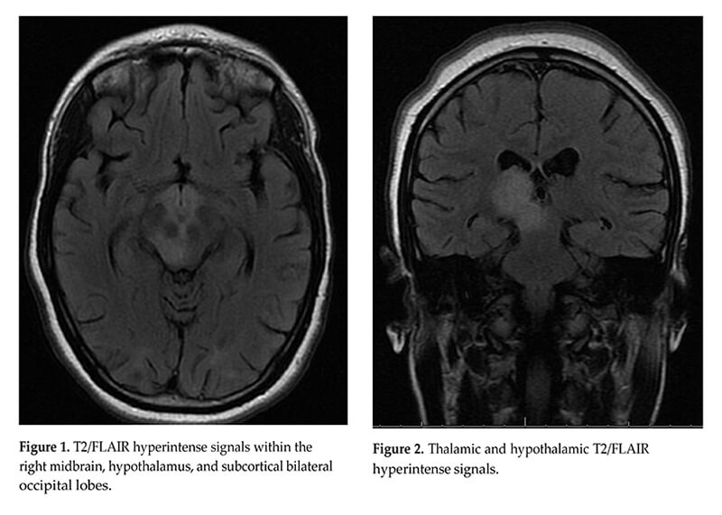 nmosd figure 1 figure 2 t2 flair